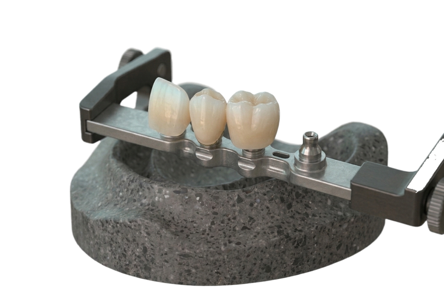 Faccette Dentali e Intarsi - Laboratorio Odontotecnico Bertolini