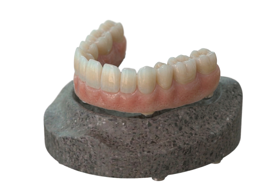 Lavori in Zirconia - Laboratorio Odontotecnico Bertolini
